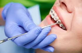 Orthodontics / Braces in Visakhapatnam