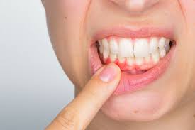 Periodontal / Gum Care in Visakhapatnam