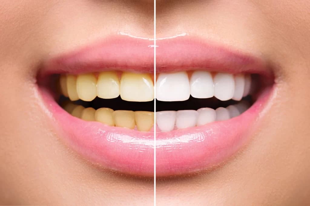Teeth Whitening in Visakhapatnam