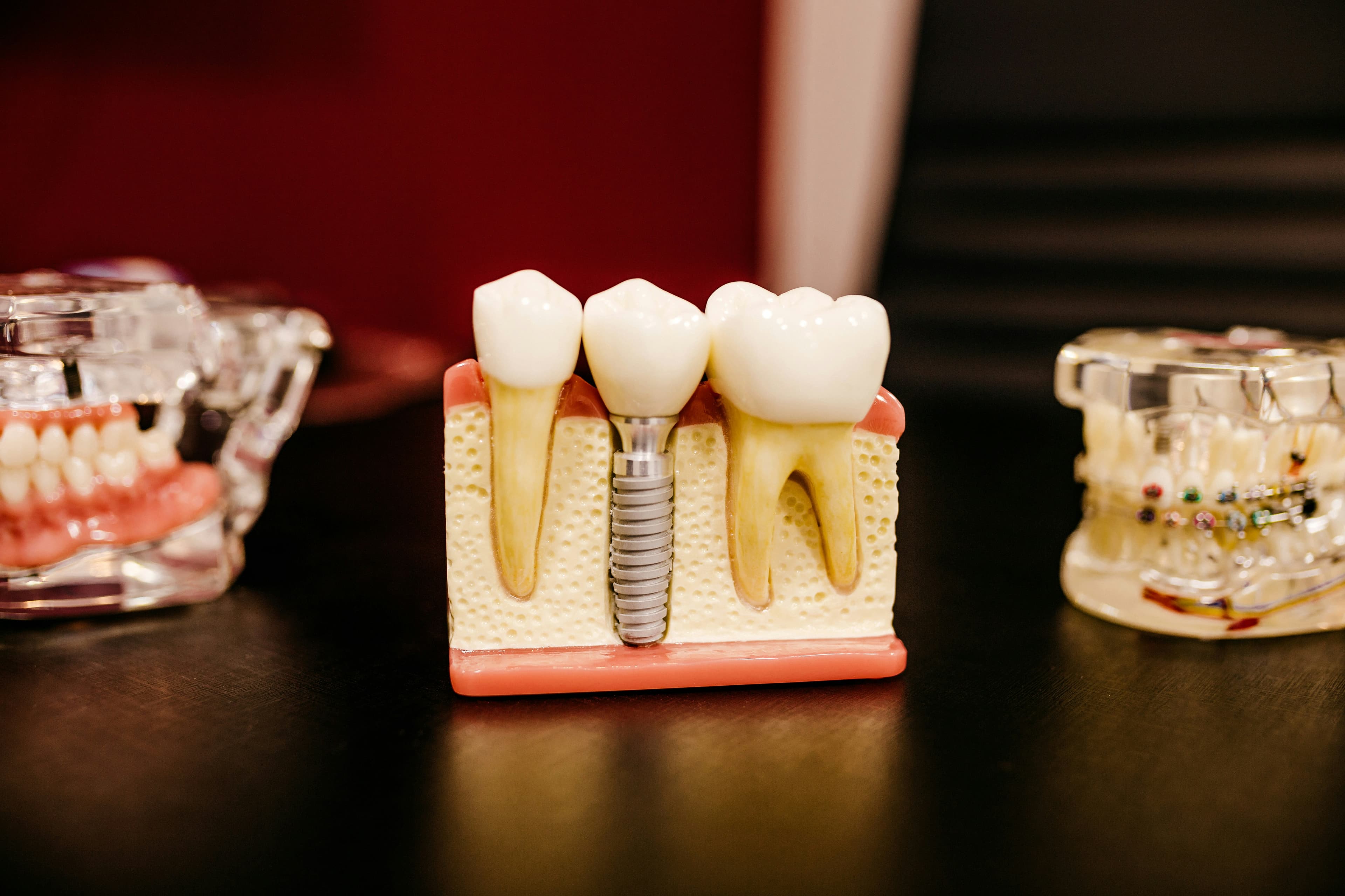 Dental Implants in Visakhapatnam